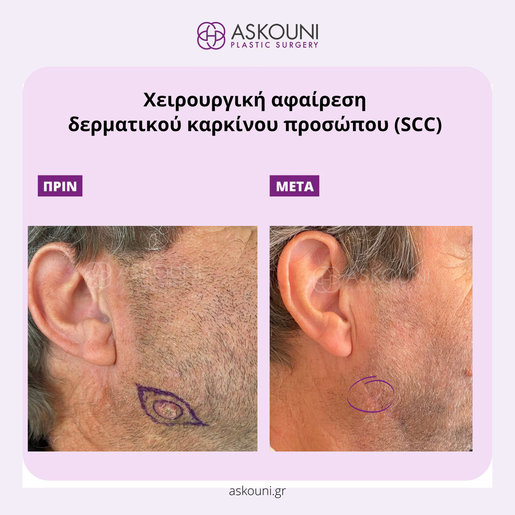 Removal of Skin Cancer - Face