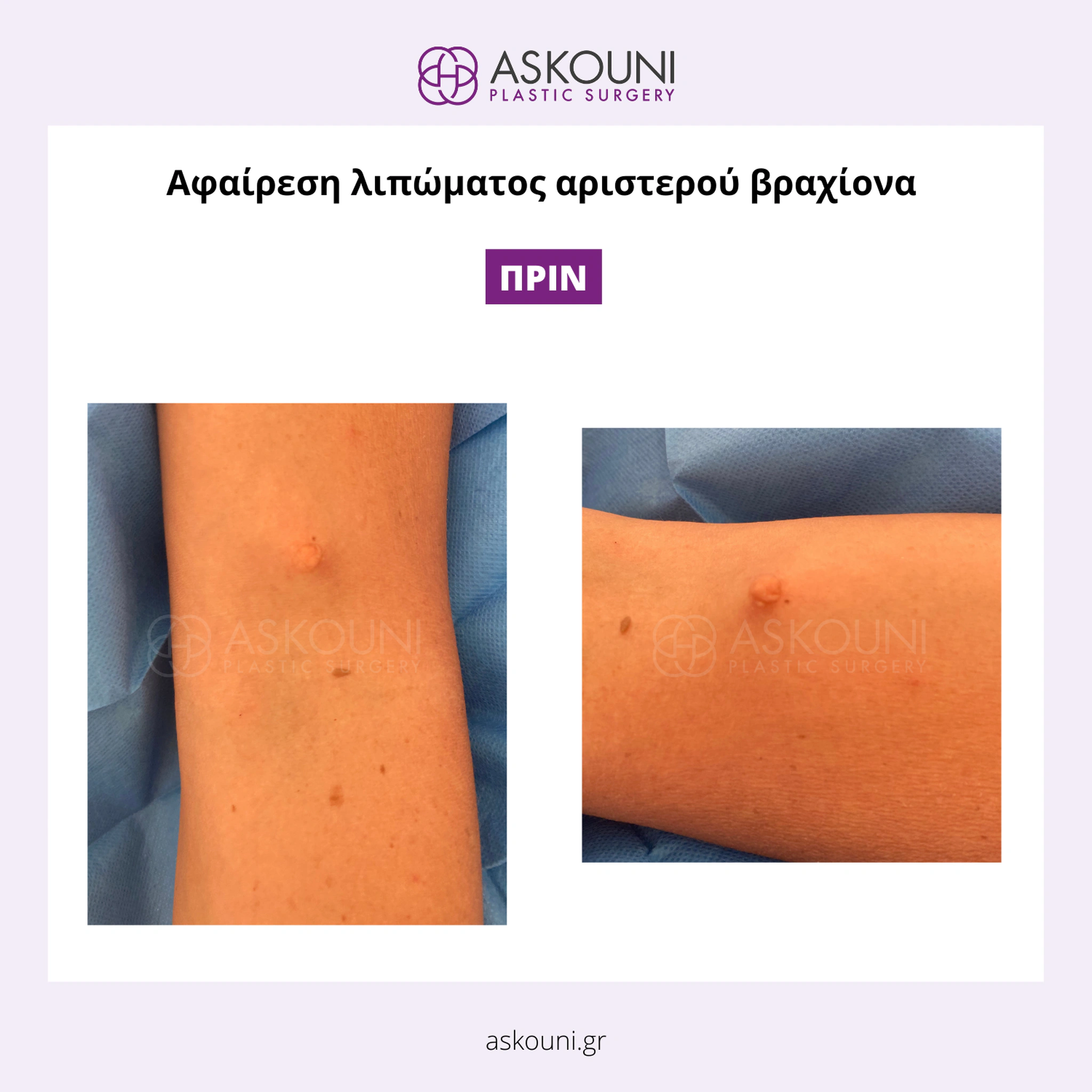 Removal of Lipoma - Arm