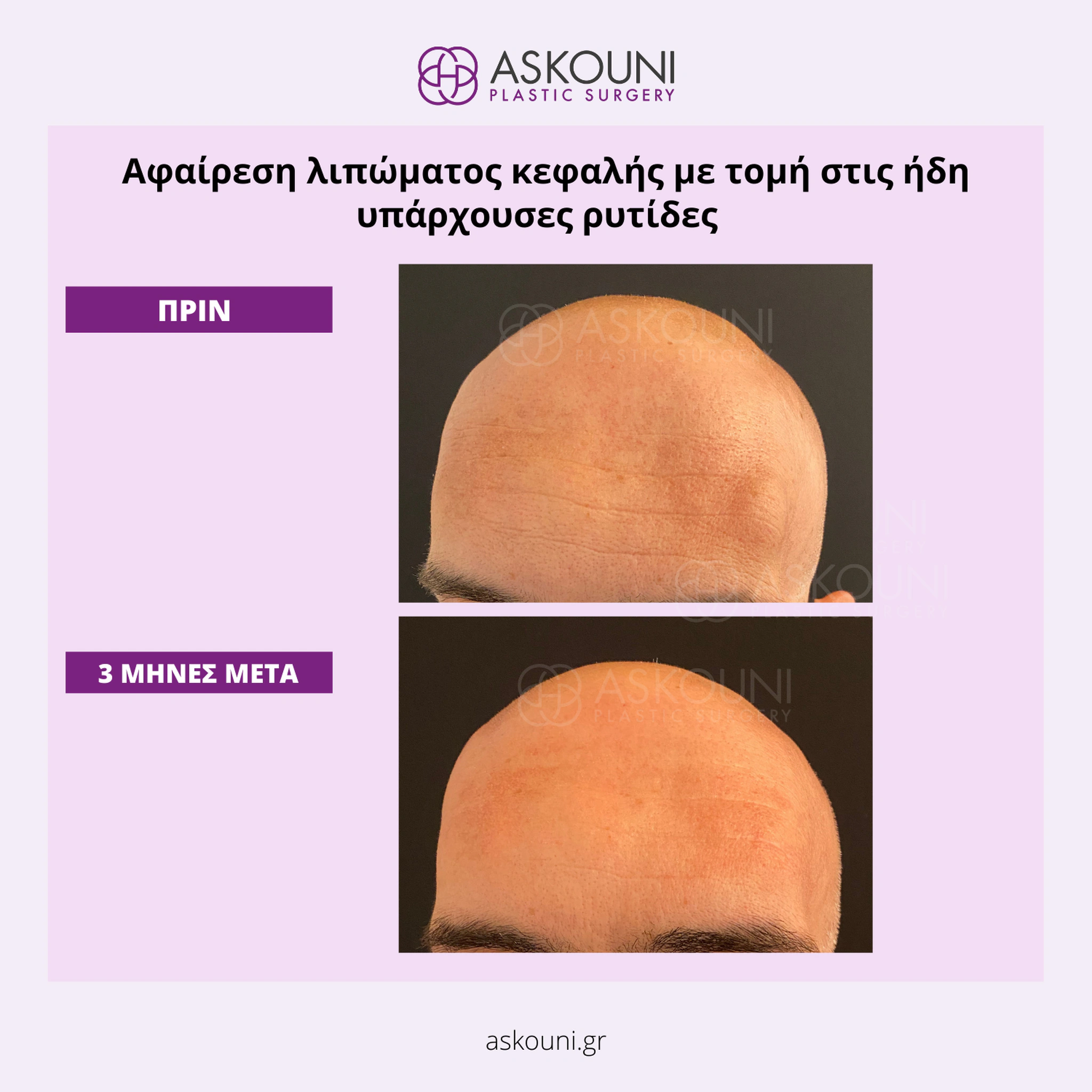 Removal of Lipomas - Head