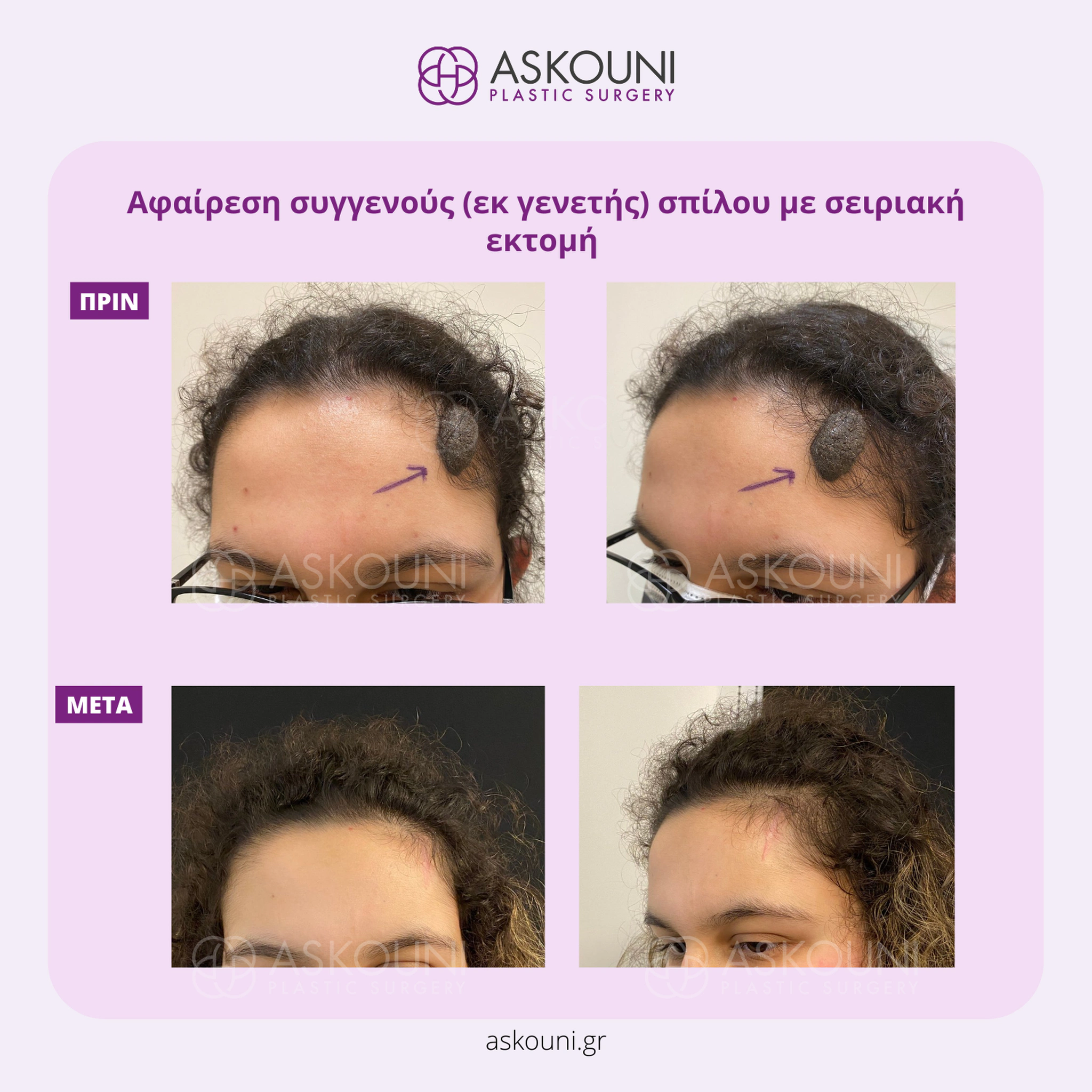 Removal of Congenital Mole - Head