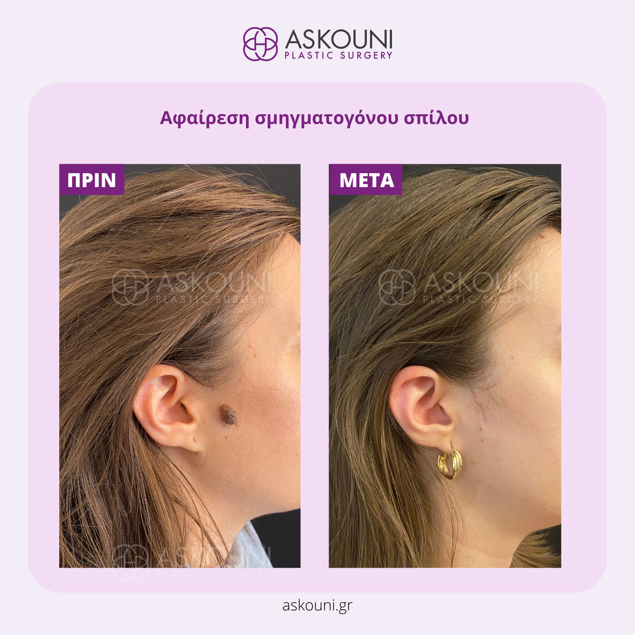 Removal of Mole - Face