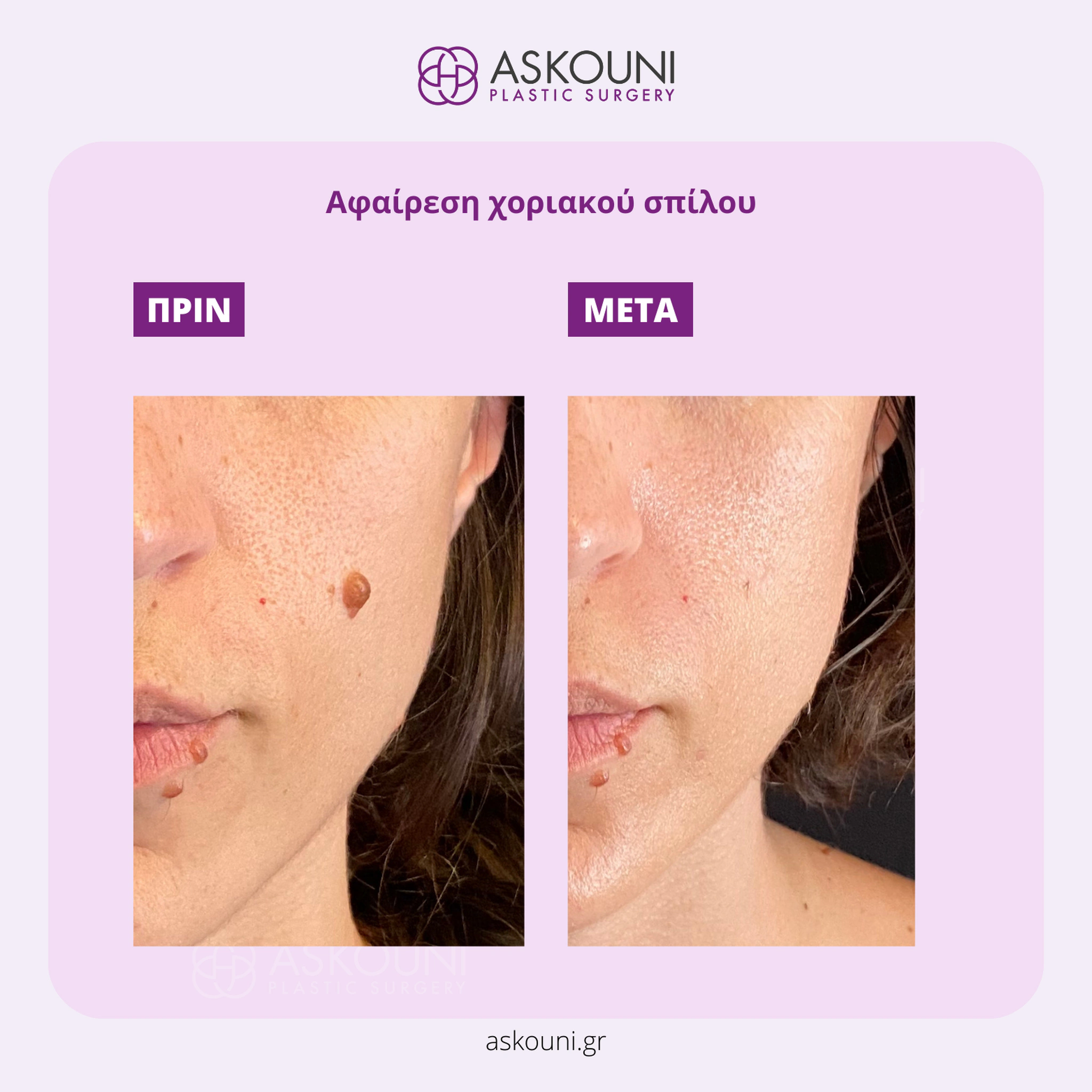 Removal of Mole - Face