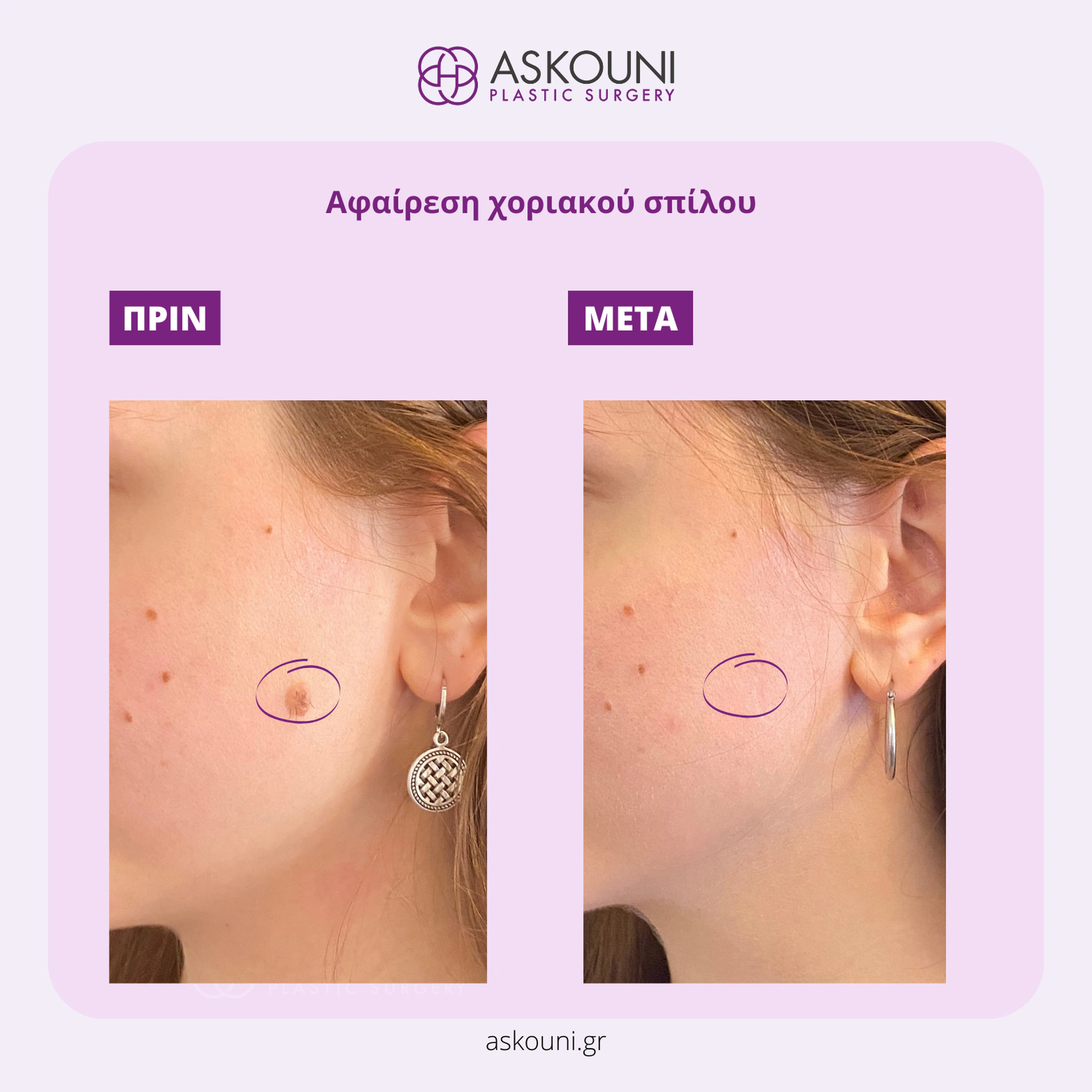 Removal of Mole - Face