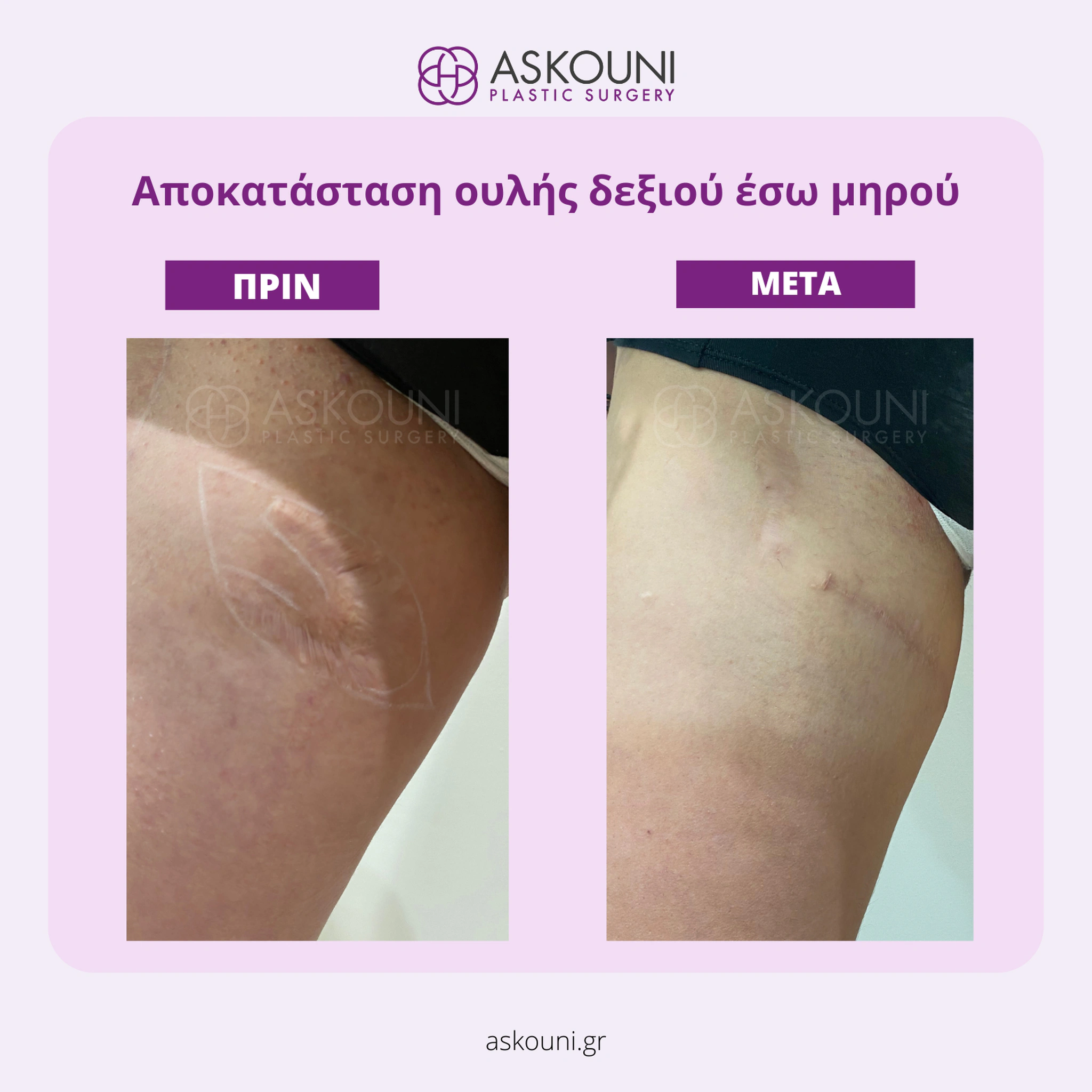 Scar Revision - Thigh