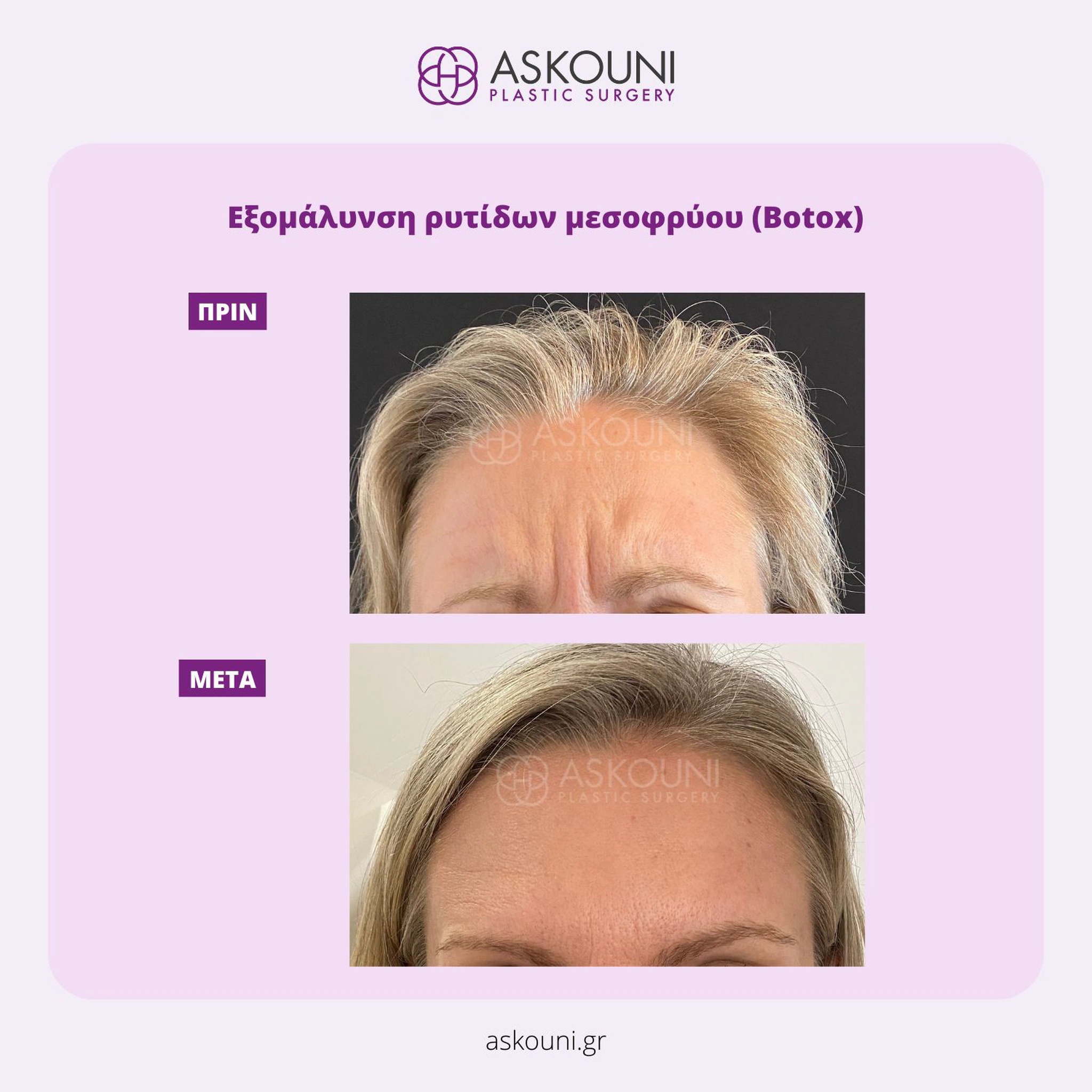Botox/Dysport for Glabella
