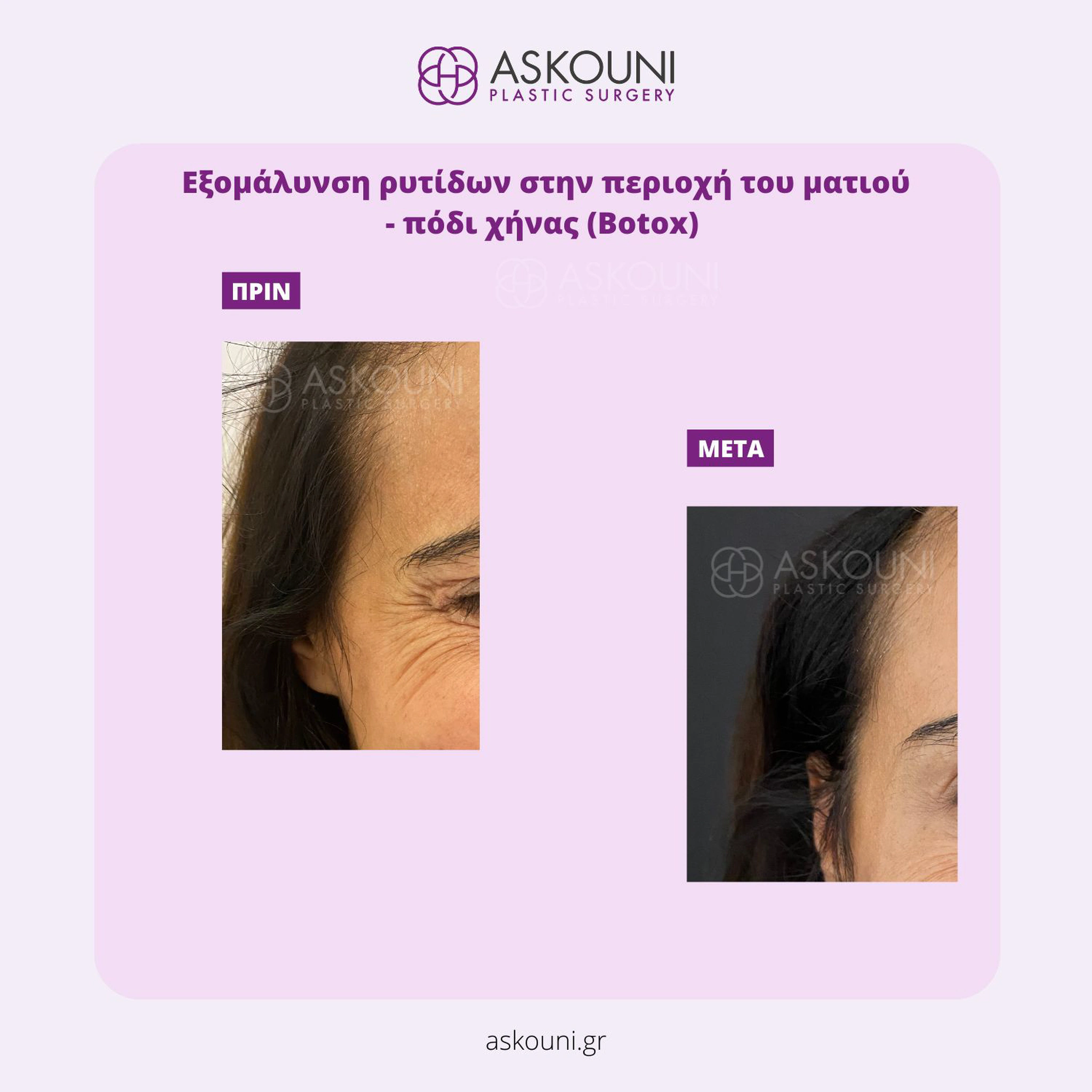 Botox/Dysport for Crow’s Feet