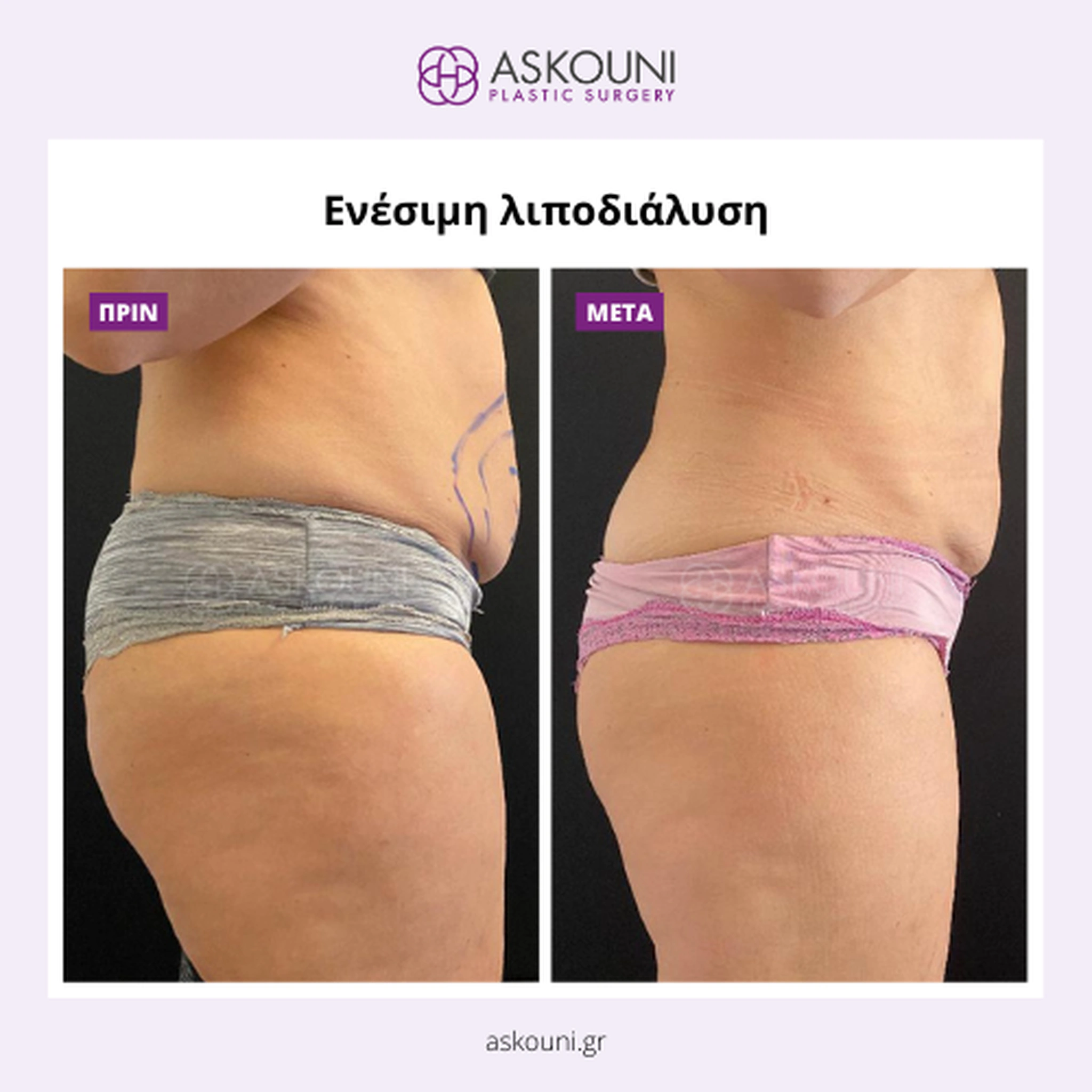 Fat Removal (Aqualyx) - Female
