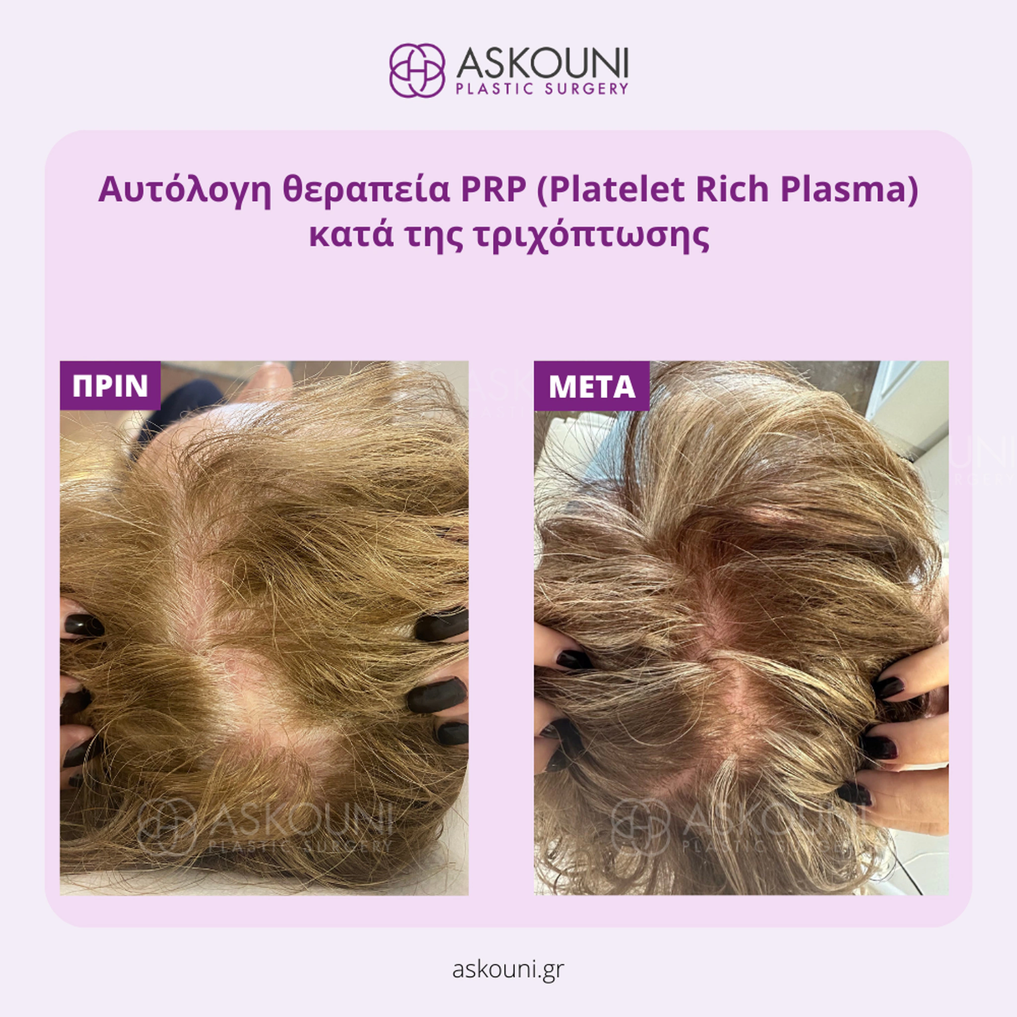 Hair Loss PRP Therapy - Female