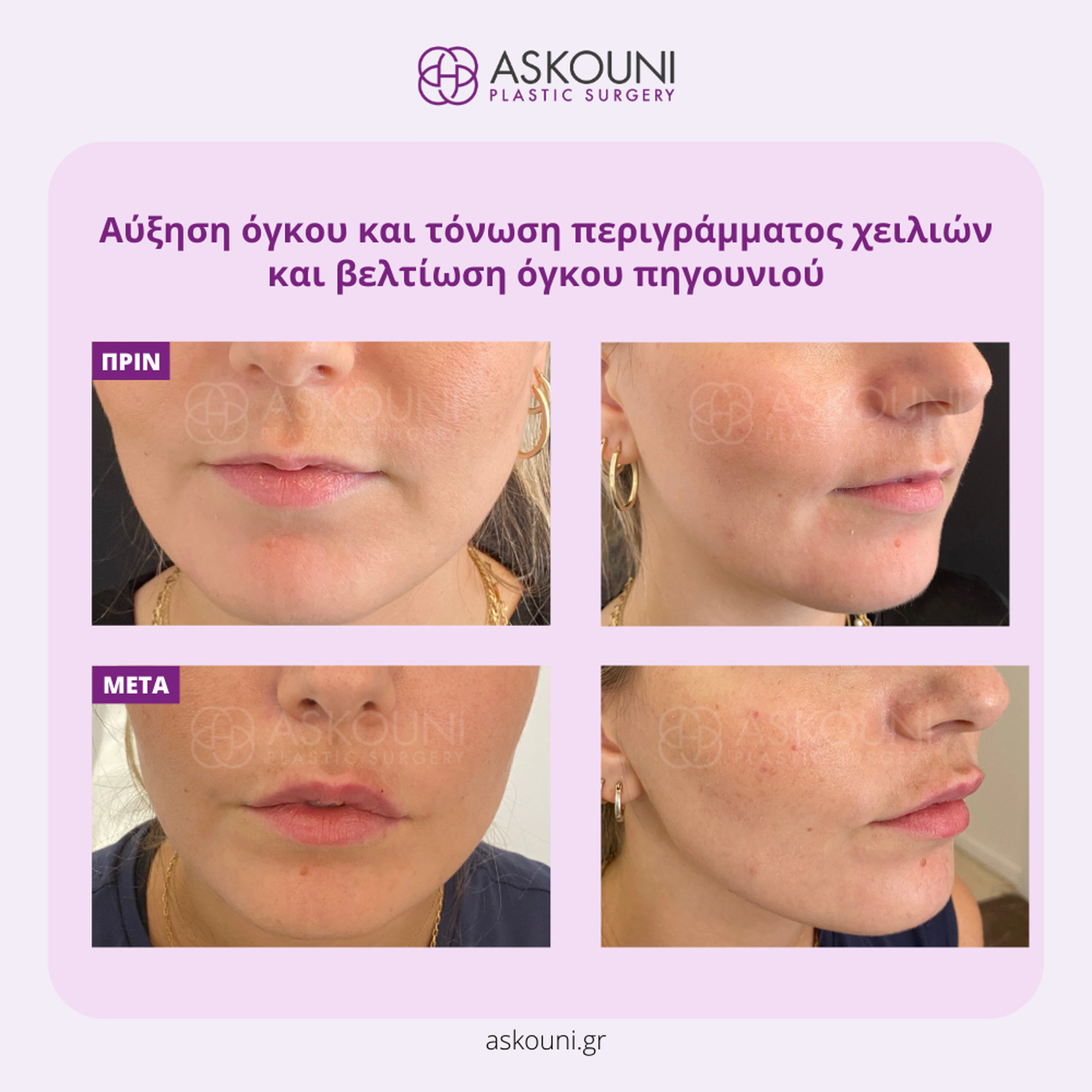 Lips & Chin Augmentation using Filler