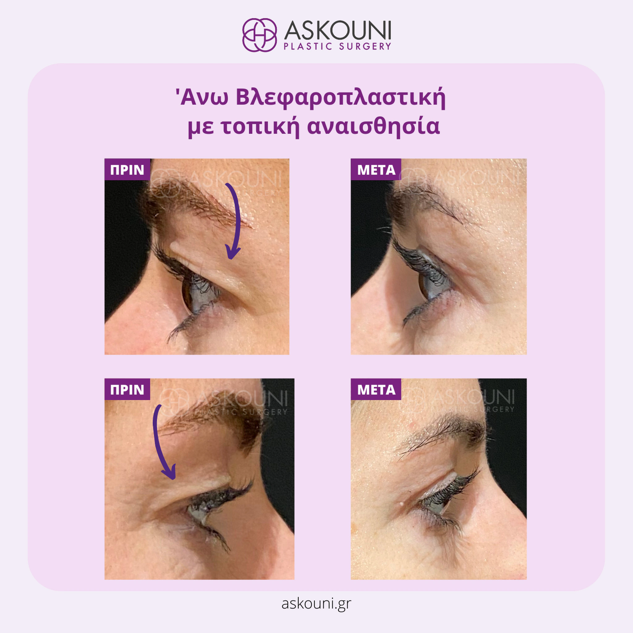Upper Blepharoplasty under Local Anaesthesia