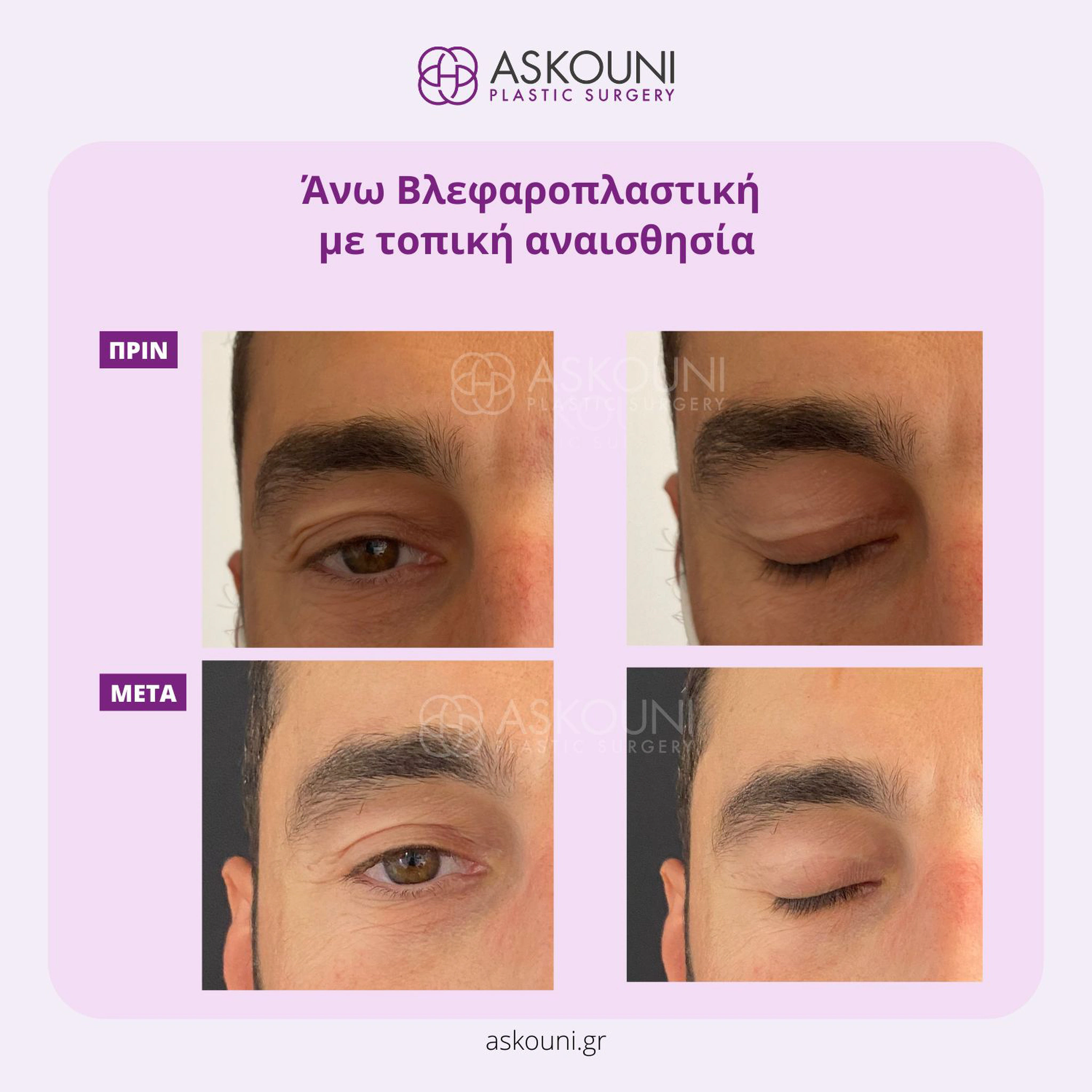 Upper Blepharoplasty under Local Anaesthesia