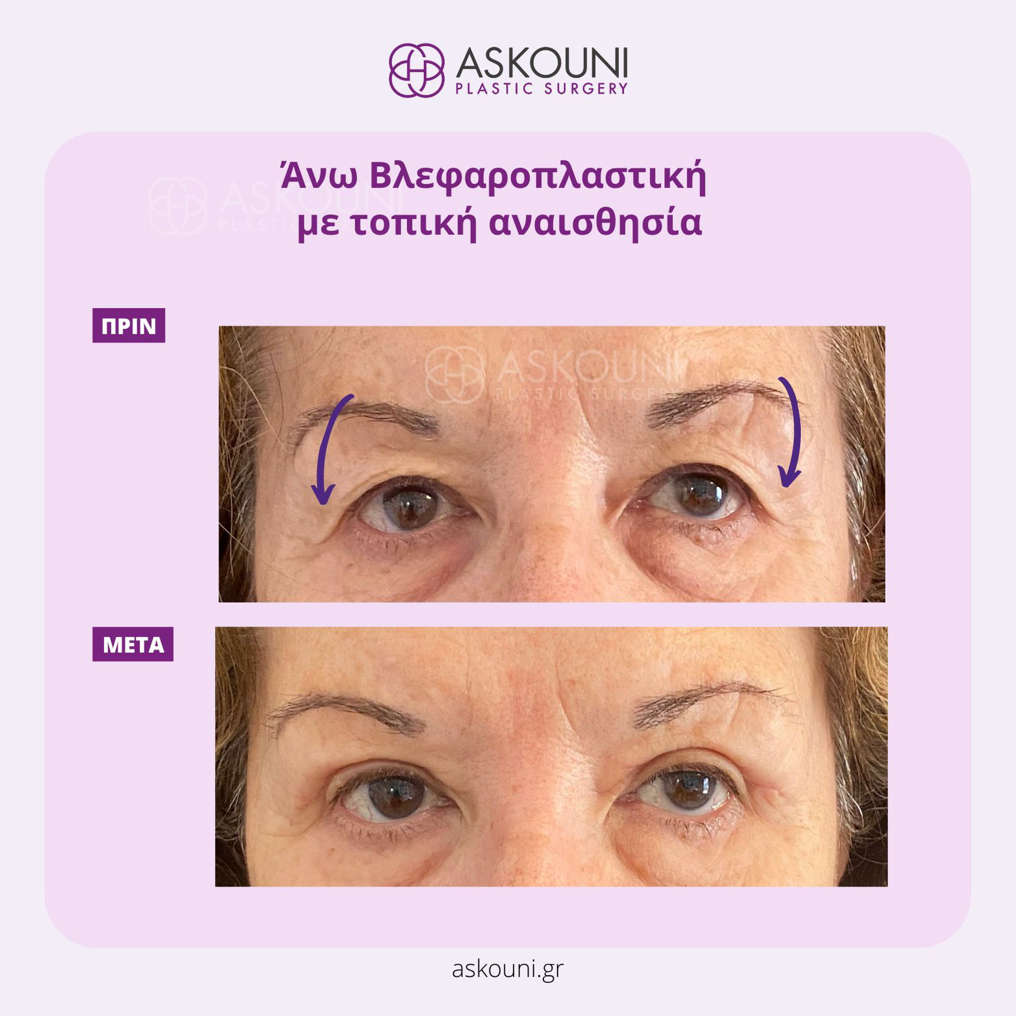 Upper Blepharoplasty under Local Anaesthesia