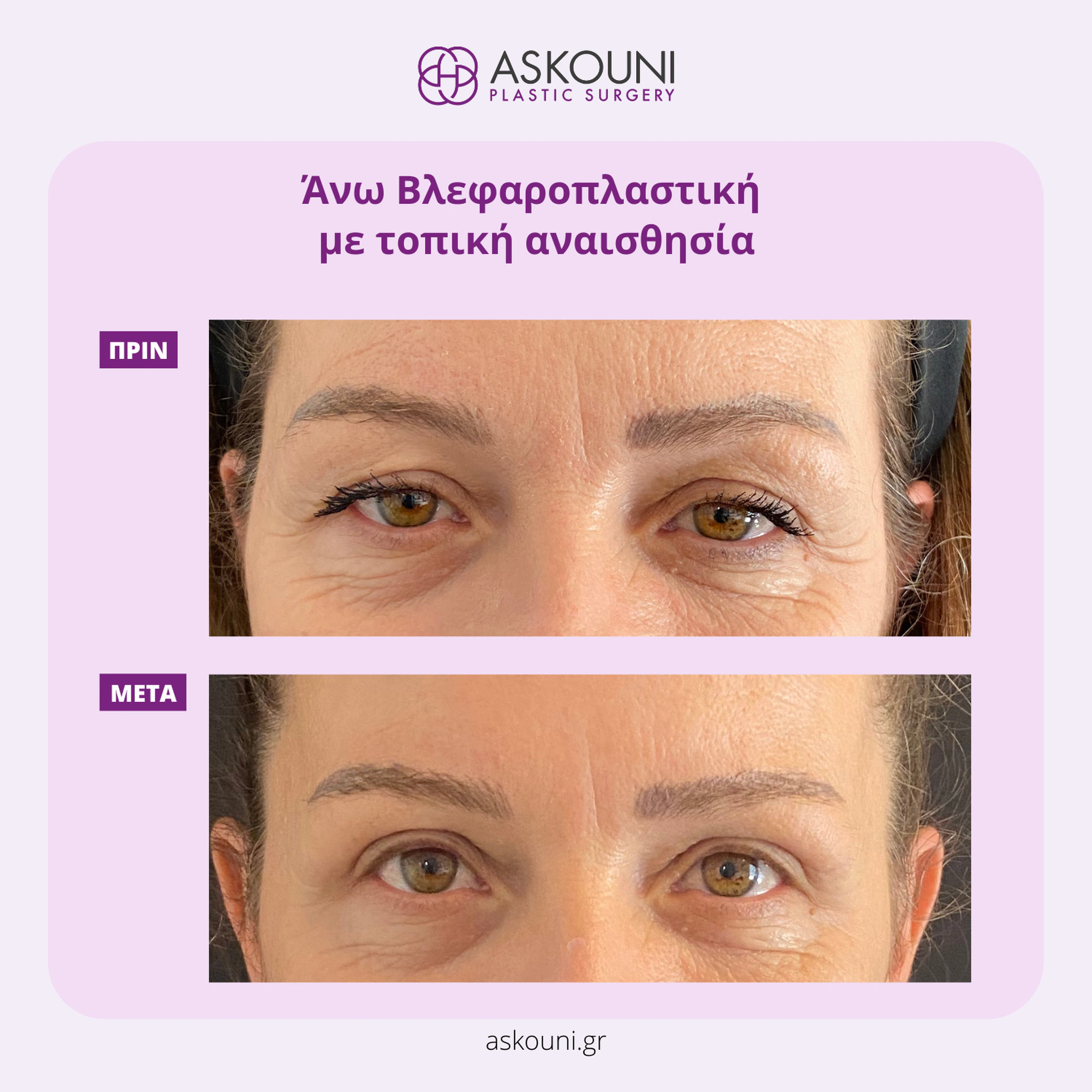 Upper Blepharoplasty under Local Anaesthesia