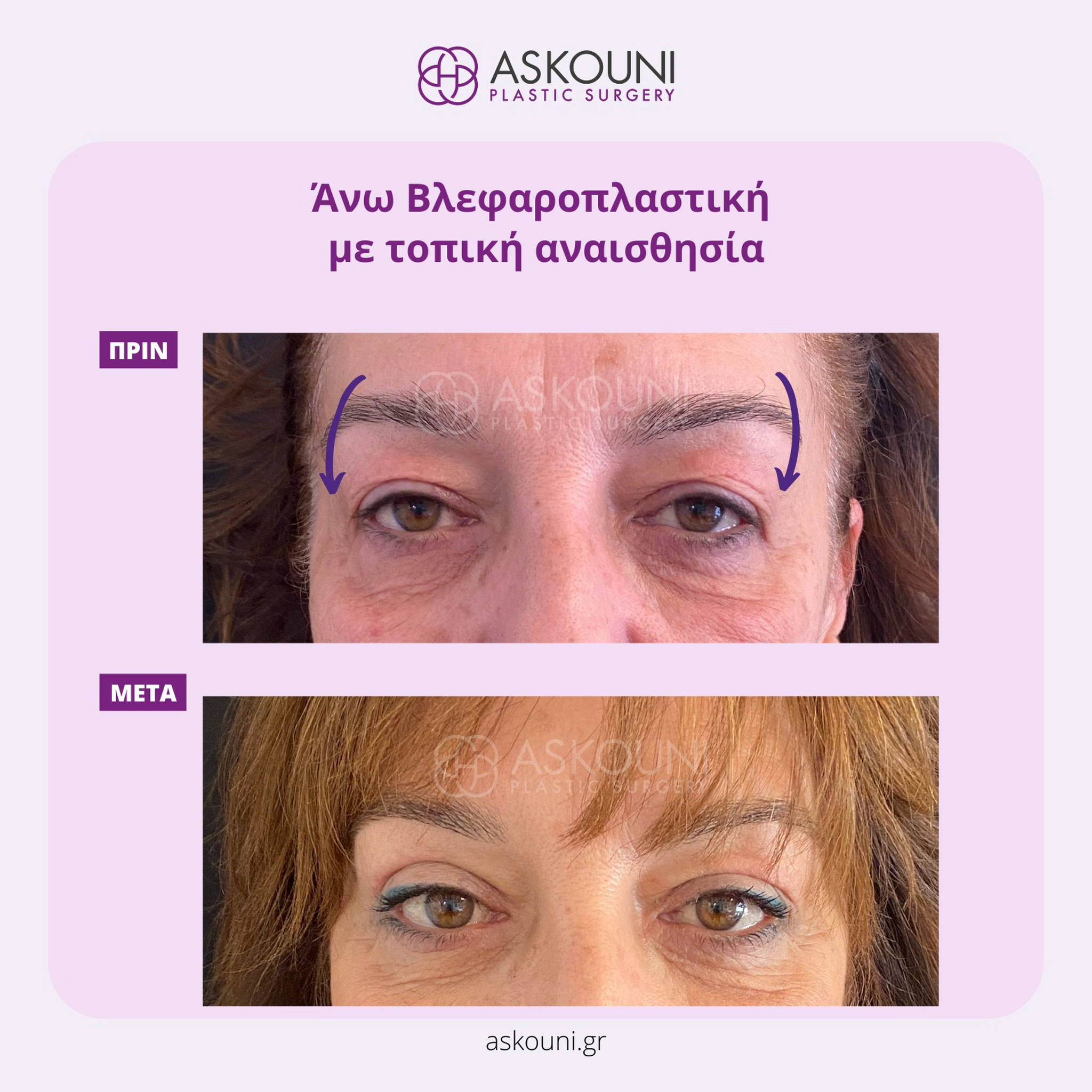 Upper Blepharoplasty under Local Anaesthesia