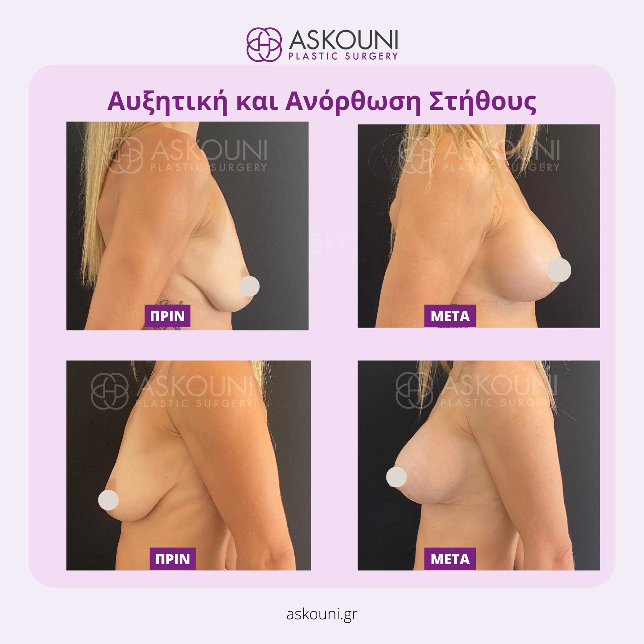 Breast Augmentation & Lift