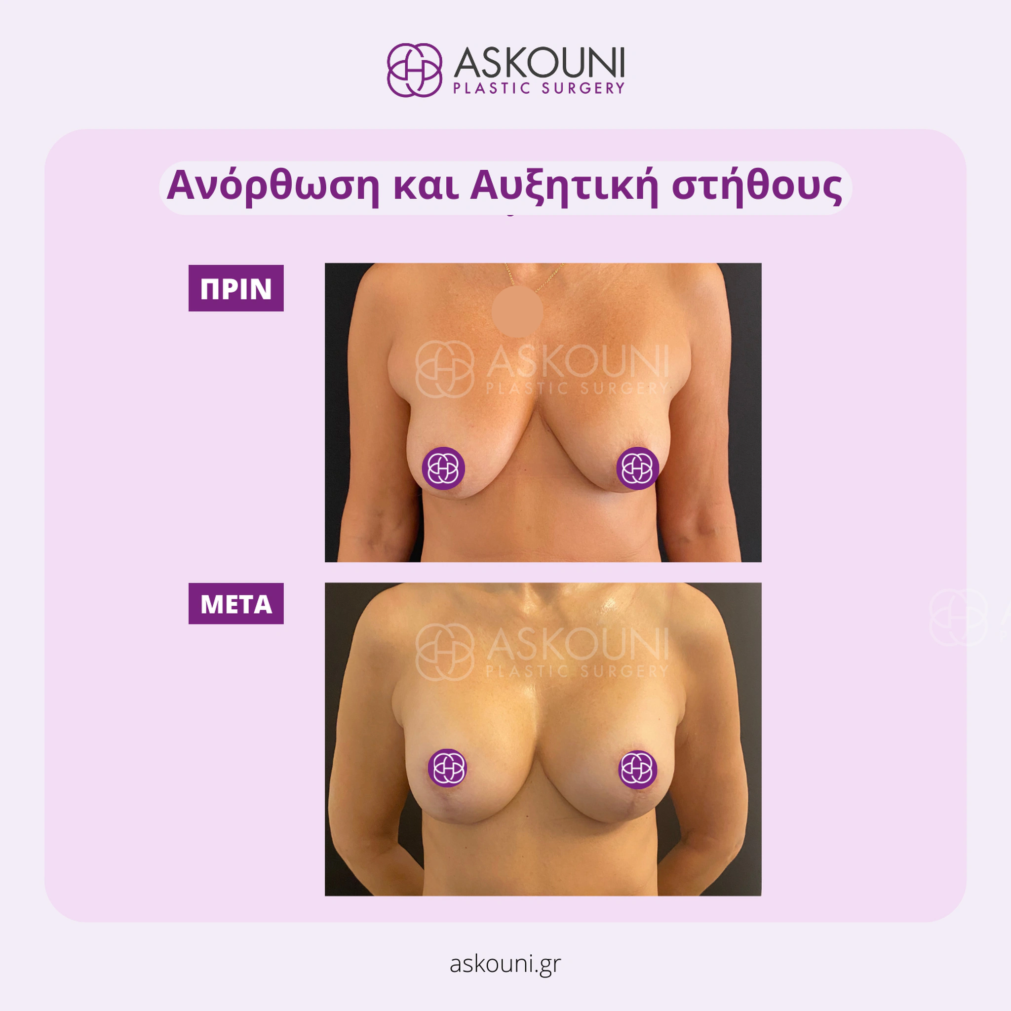 Breast Augmentation & Lift