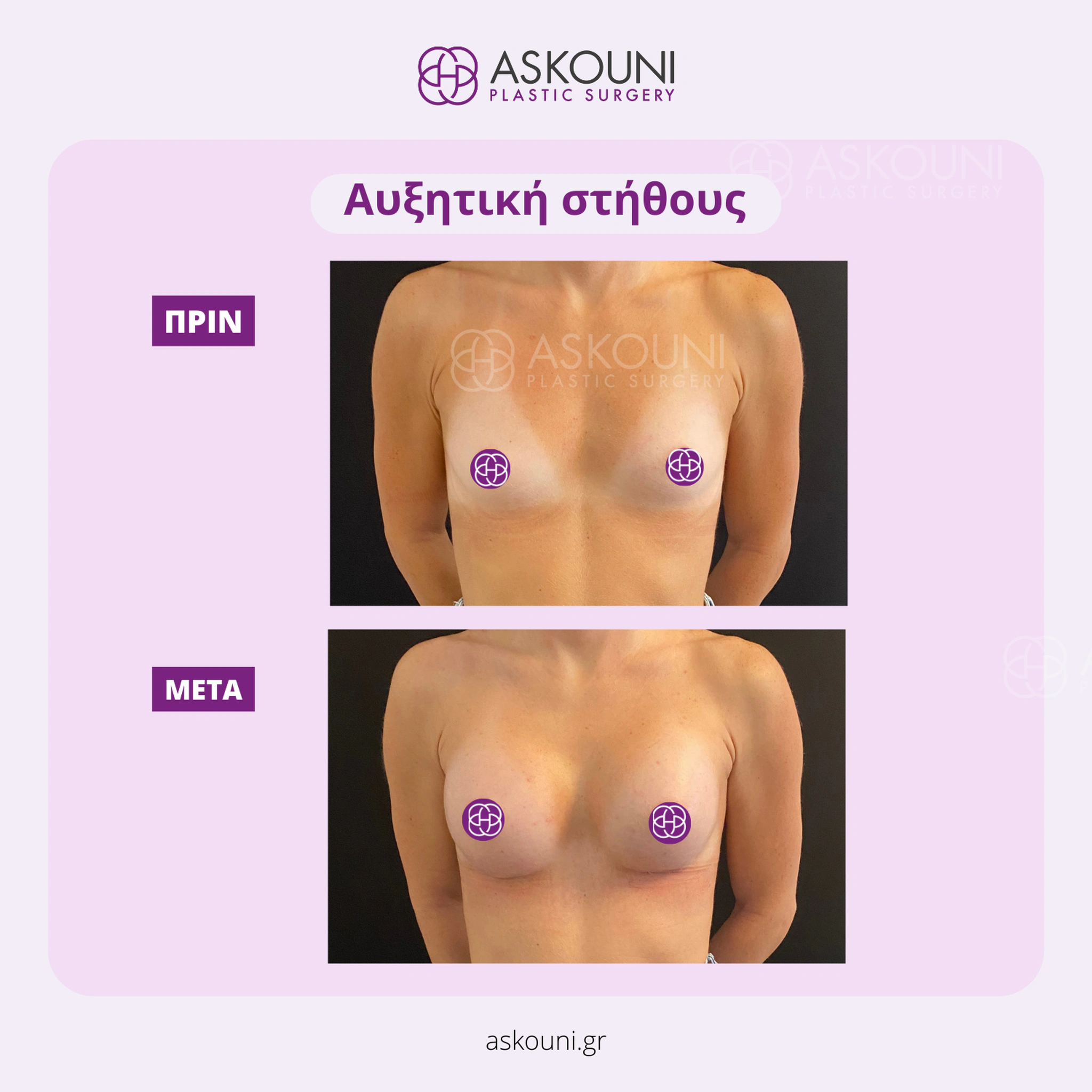 Breast Augmentation
