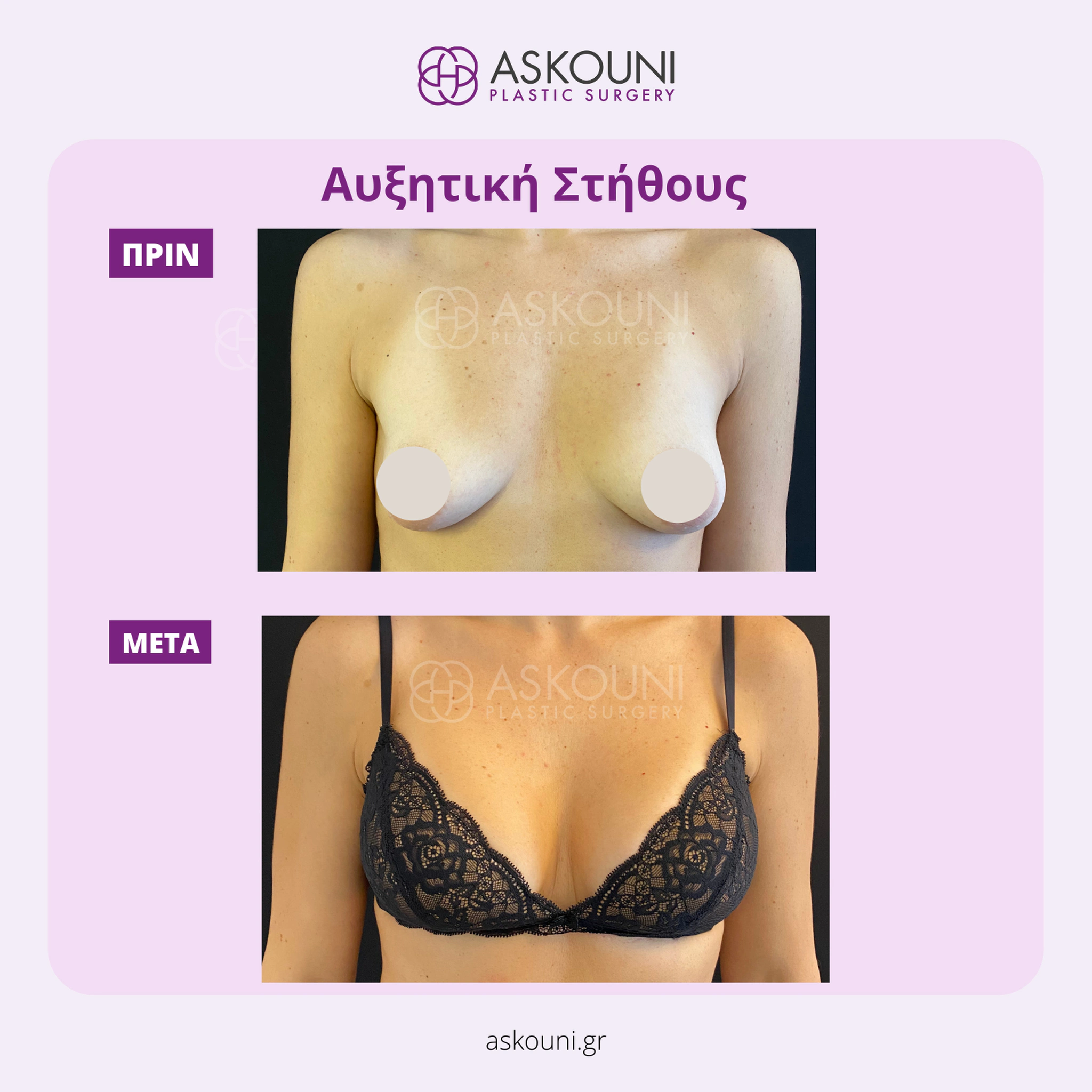 Breast Augmentation