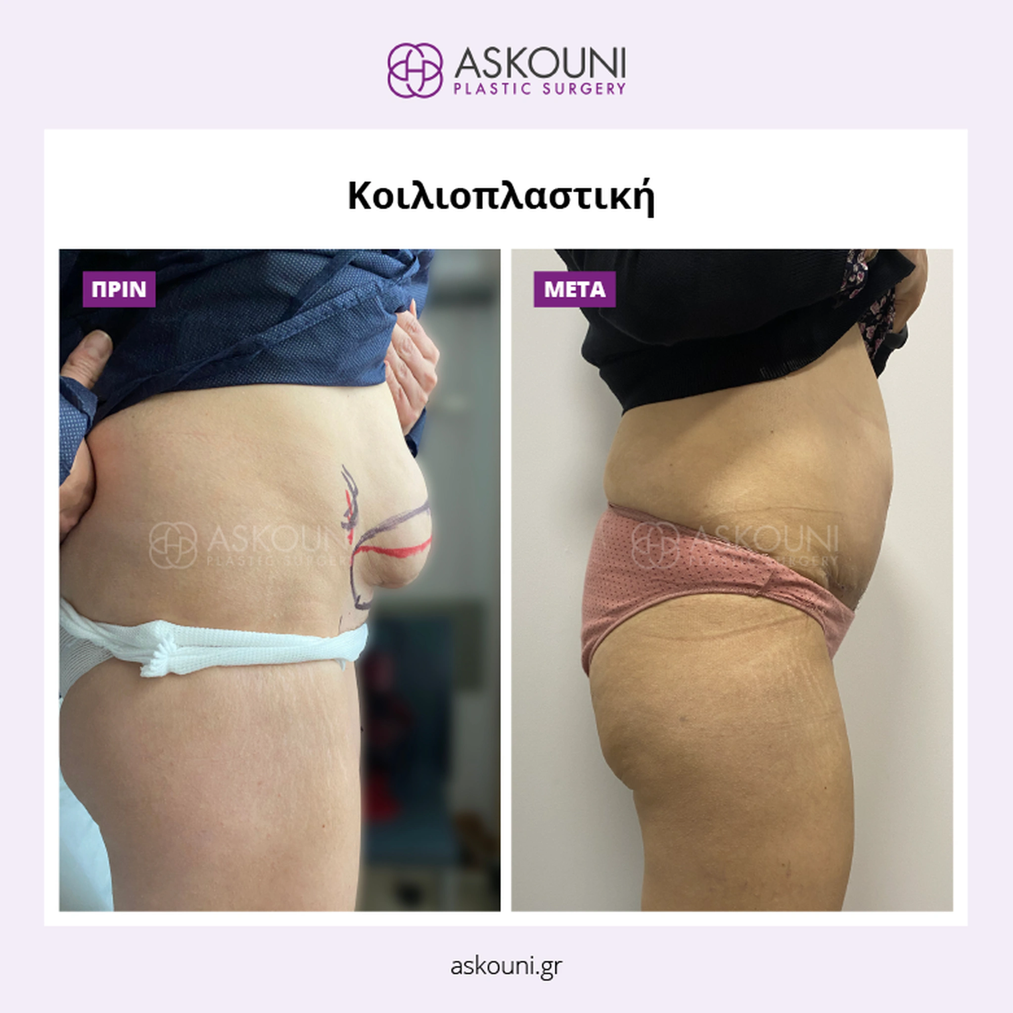 Abdominoplasty - Female