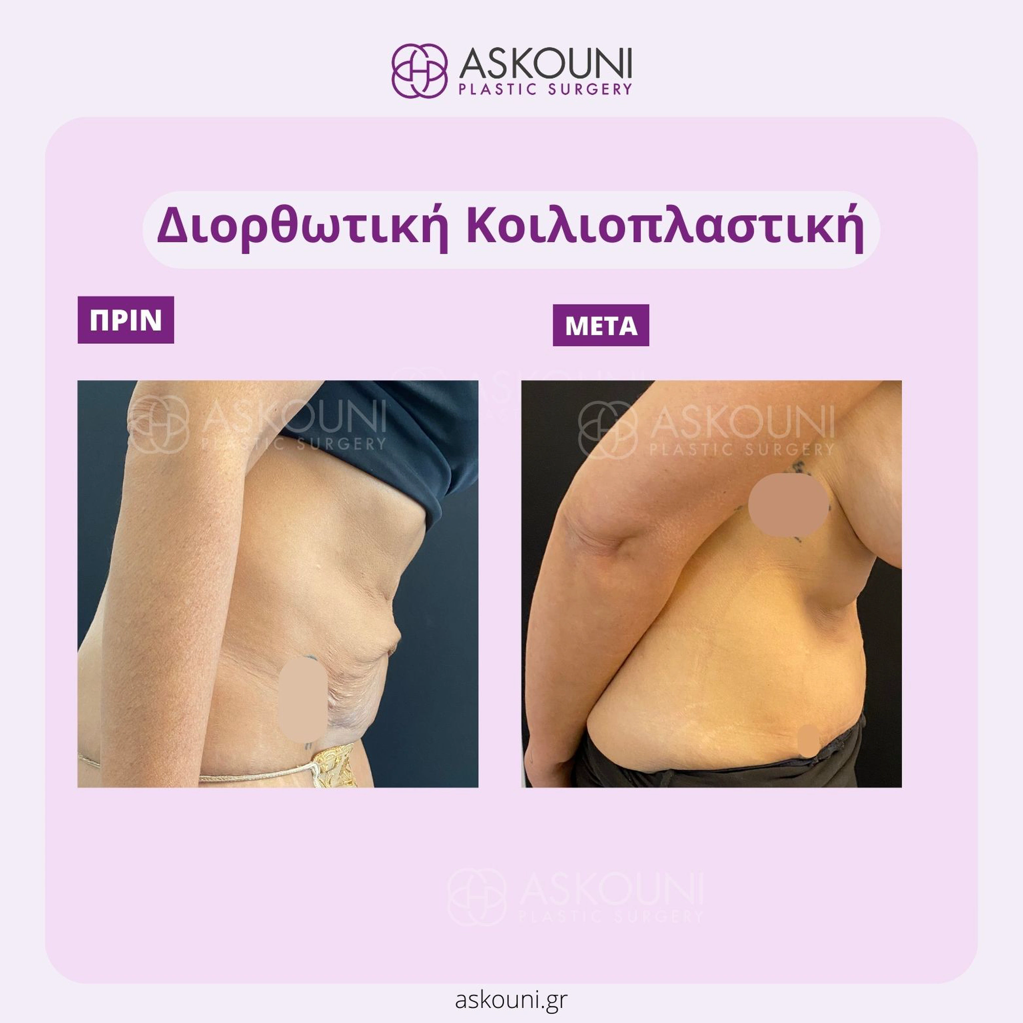 Abdominoplasty - Female