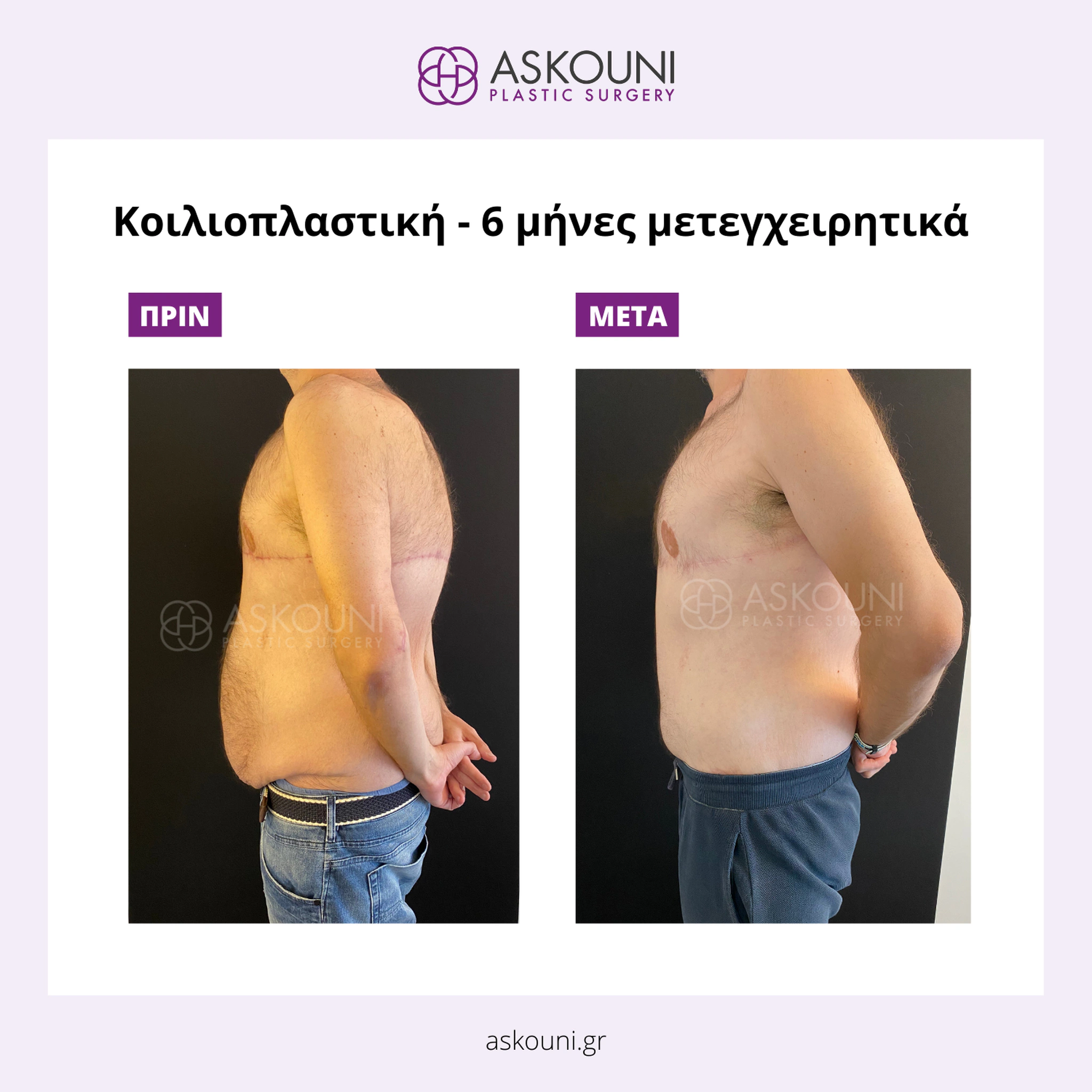 Abdominoplasty - Male