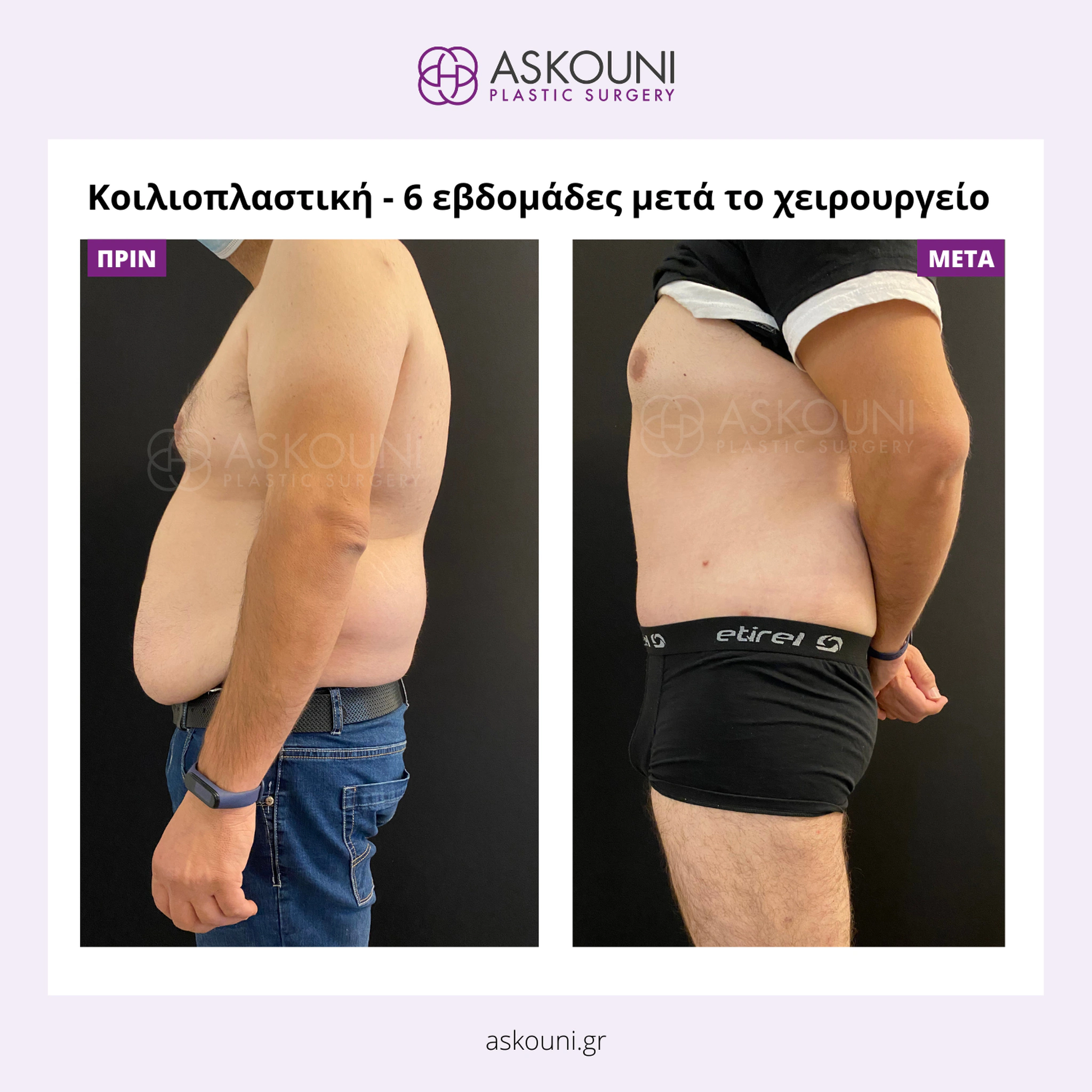 Abdominoplasty - Male