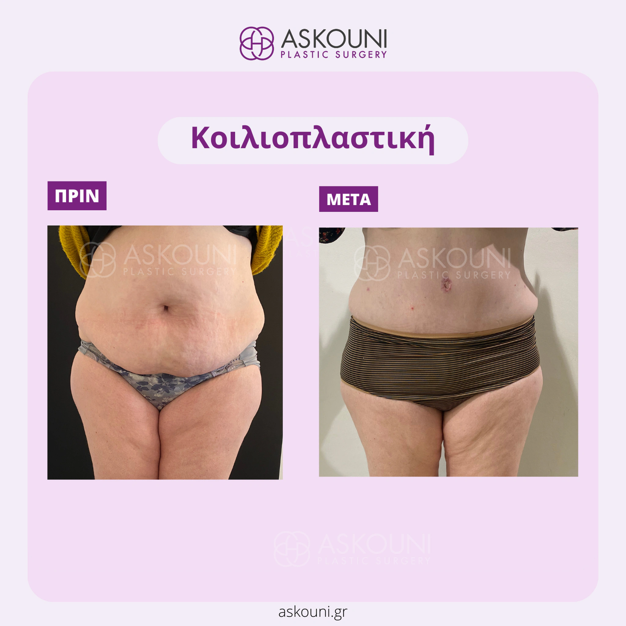 Abdominoplasty - Female