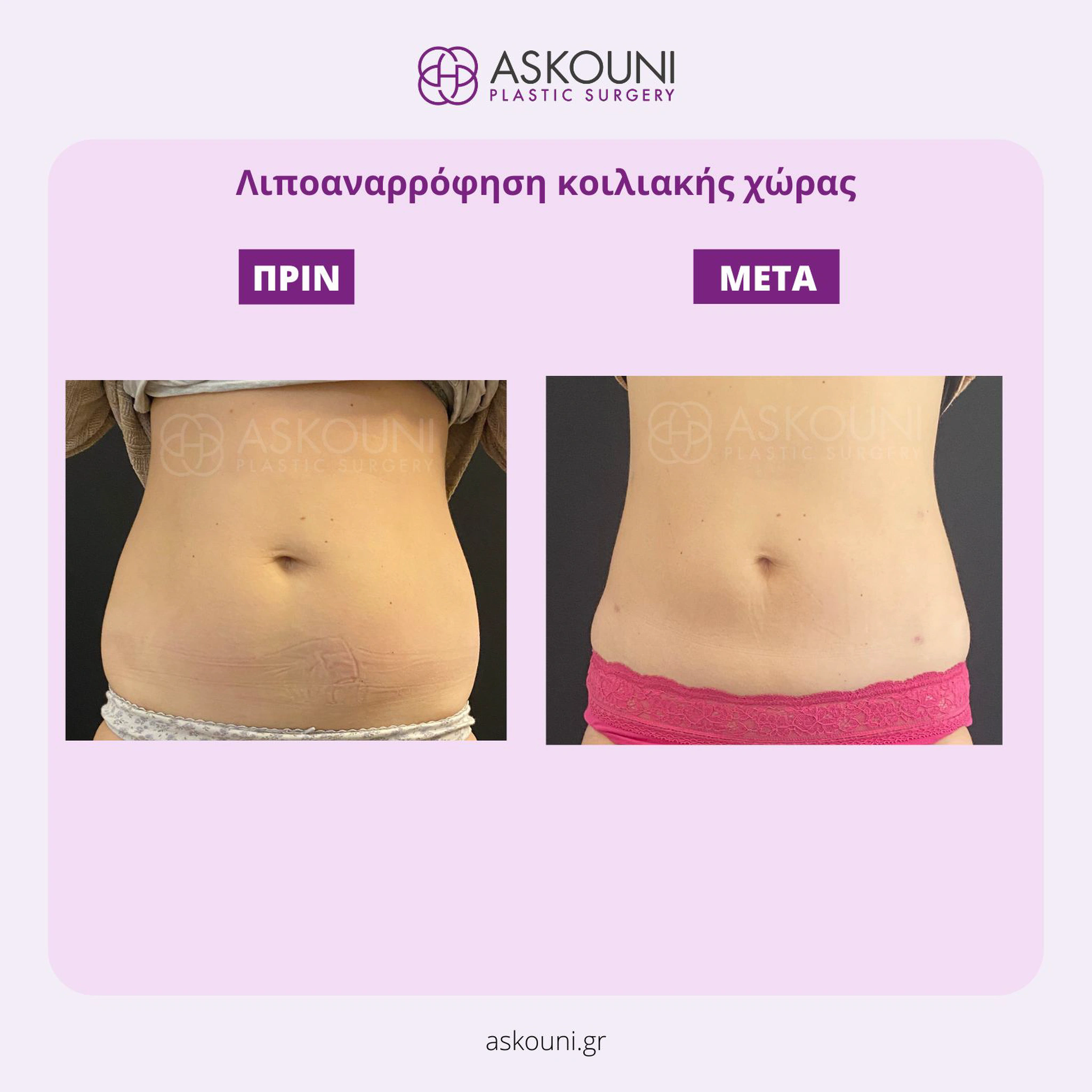 Abdominal Liposuction - Female