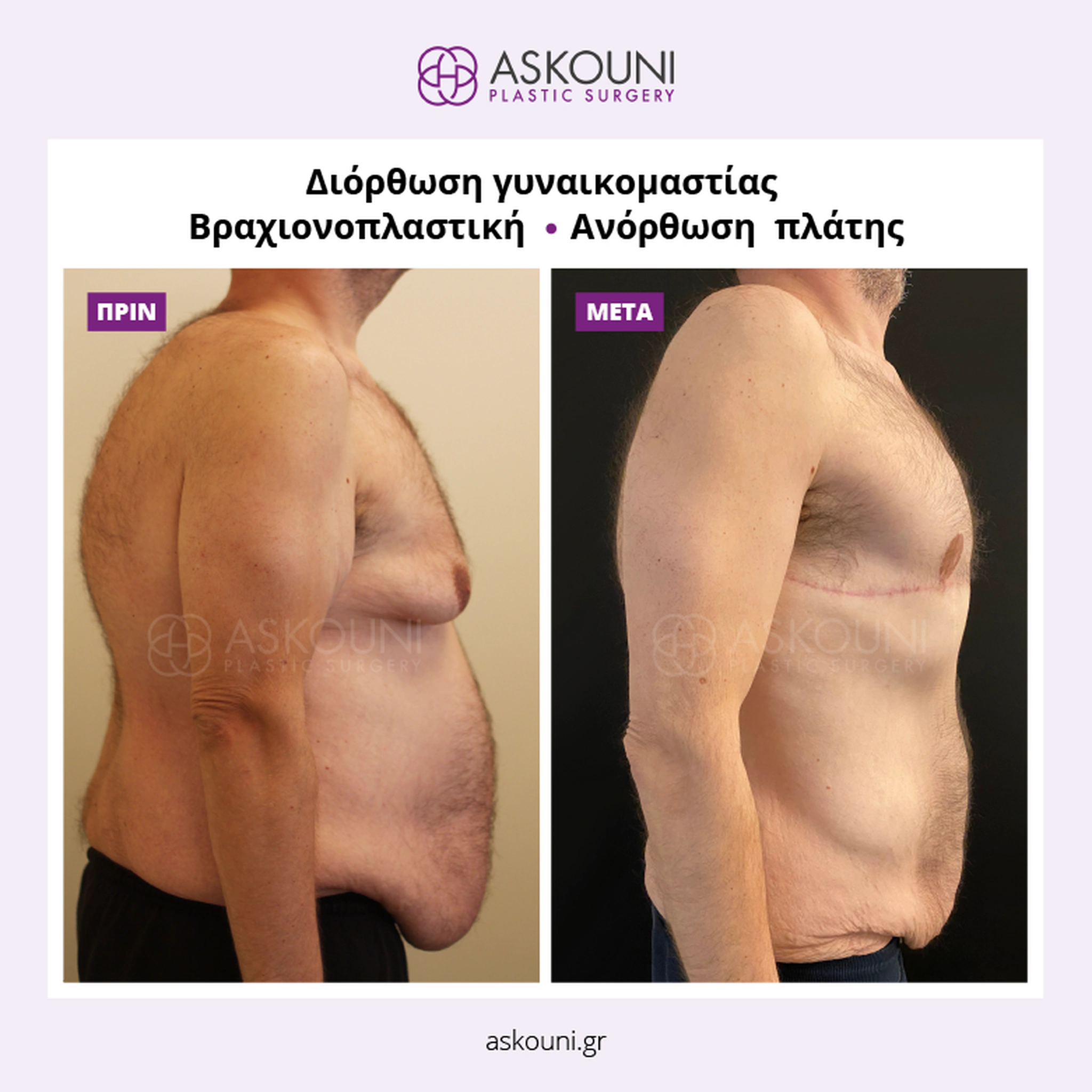 Post-Bariatric Surgery (After Weight Loss)