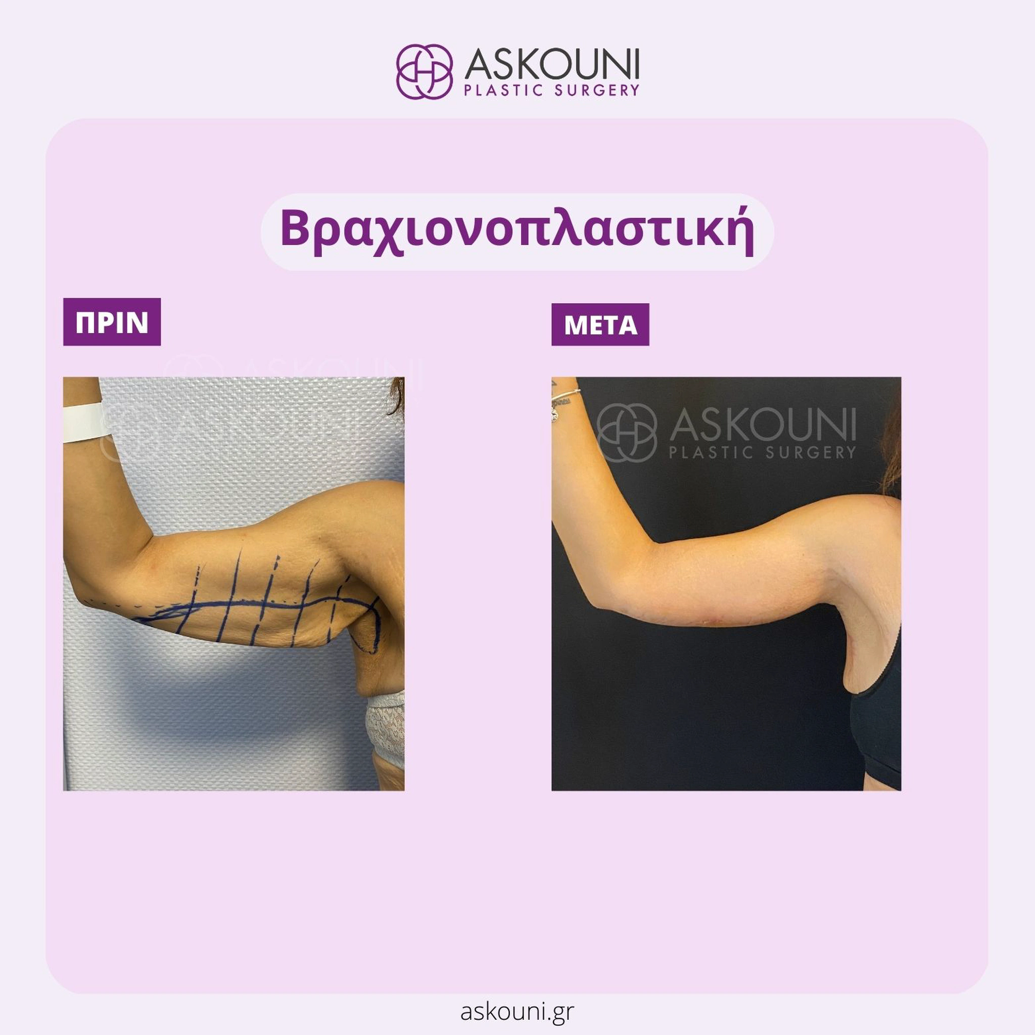 Vrachioplasty - Female