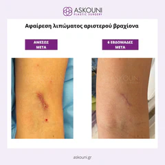 Removal of Lipoma - Arm | Before & After