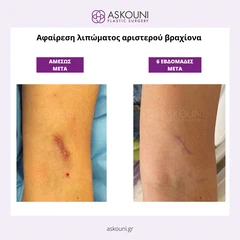 Αφαίρεση Λιπώματος Βραχίονα | Πριν & Μετά