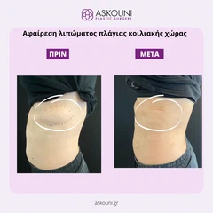 Αφαίρεση Λιπώματος Κοιλιακής Χώρας | Πριν & Μετά