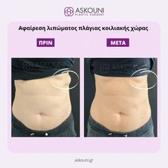 Αφαίρεση Λιπώματος Κοιλιακής Χώρας | Πριν & Μετά