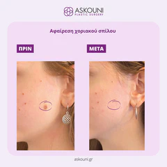 Removal of Mole - Face | Before & After