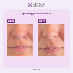Removal of Moles - Nose | Before & After
