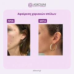 Αφαίρεση Χοριακών Σπίλων - Πρόσωπο | Πριν & Μετά