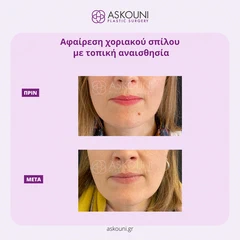 Αφαίρεση Χοριακού Σπίλου - Πρόσωπο | Πριν & Μετά