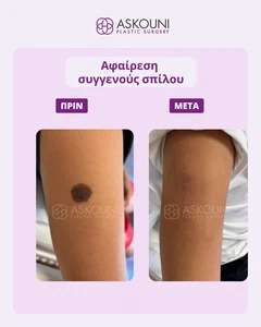 Αφαίρεση Συγγενούς Σπίλου - Χέρι - 2 Εβδομάδες Μετά | Πριν & Μετά