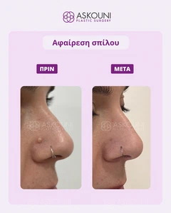Removal of Mole - Nose - 3 Months After | Before & After