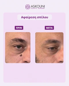 Αφαίρεση Μελαγχρωματικού Σπίλου - 4 Μήνες Μετά | Πριν & Μετά