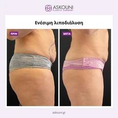 Λιποδιάλυση με Aqualyx - Γυναίκα | Πριν & Μετά