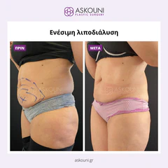 Fat Removal (Aqualyx) - Female | Before & After
