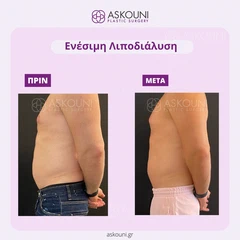 Λιποδιάλυση με Aqualyx - Άνδρας | Πριν & Μετά