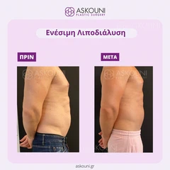 Λιποδιάλυση με Aqualyx - Άνδρας | Πριν & Μετά