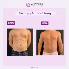 Λιποδιάλυση με Aqualyx - Άνδρας | Πριν & Μετά
