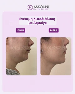 Chin Fat Removal (Aqualyx) - Female | Before & After