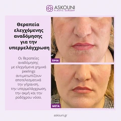 Θεραπεία Αναδόμησης για Υπερμελάγχρωση | Πριν & Μετά