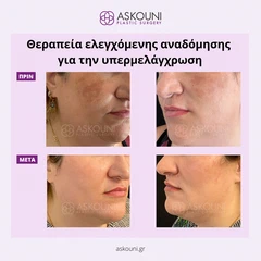 Θεραπεία Αναδόμησης για Υπερμελάγχρωση | Πριν & Μετά