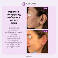 Θεραπεία Αναδόμησης για Ακμή | Πριν & Μετά